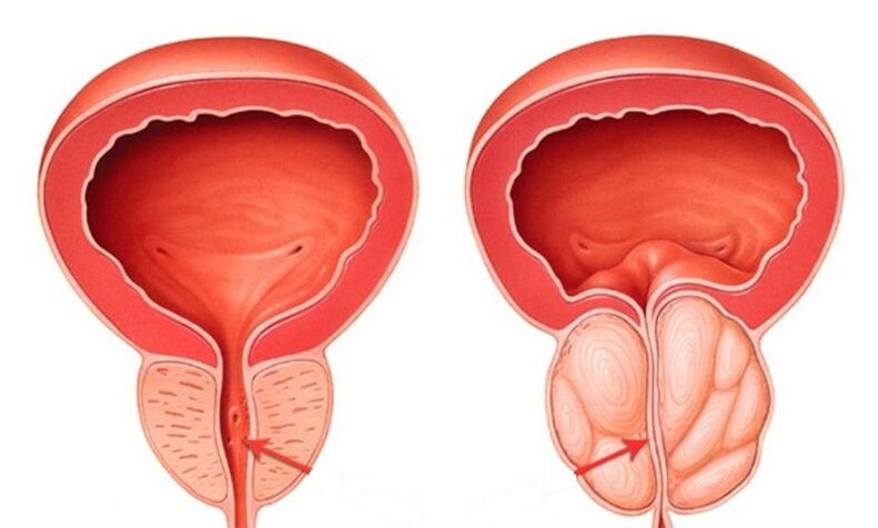 Healthy prostate and inflamed with prostatitis